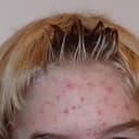 ACNE