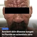 Leprosy