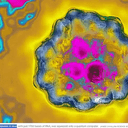 Hepatitis